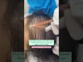 Download Lagu {2024 } PRP - Best hair loss treatment for females #shorts