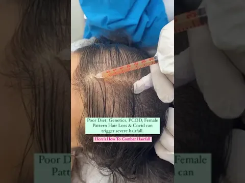 Download MP3 PRP - Best hair loss treatment for females #shorts