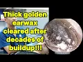Lagu Thick golden earwax cleared after decades of build | ear cleaning | ASMR earwax | soothing |relax|