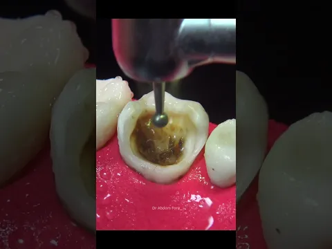 How to Remove Black Cavity  #dentist