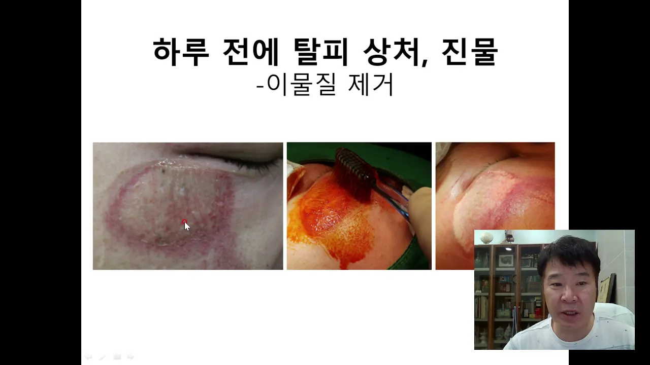 탈피(긁힌) 상처의 안전한 치료법은?