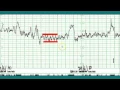 Download Lagu Ctg interpretation - Normal CTG