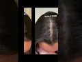 Download Lagu my hair loss journey- stress hair loss recovery