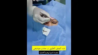 شد الجفون العلوية بمخدر موضعي 