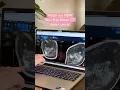 Download Lagu NEW Vera Scan Breast CT detects cancer 🤯