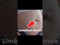 Umbilical hernia I Laparoscopic treatment of Umbilical hernia