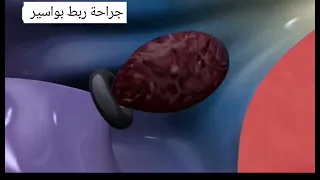 شاهد عملية البواسير الشرجية الربط علاج البواسير 