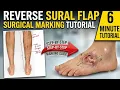 Reverse Sural Flap Step-by-Step Surgical Markings and Flap Design