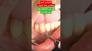 جير الاسنان تحت اللثه Dental Plaque 