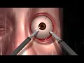 Bob Wade React To Mark s Eye Surgery