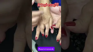 โรคข้ออักเสบรูมาตอย มีสาเหตุจากอะไร และเกิดผลกระทบอย่างไรต่อร่างกาย
