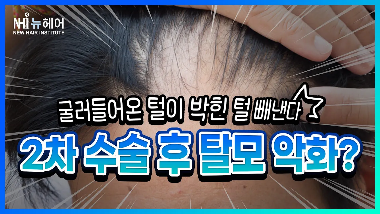 [모발이식] 2차 수술 후 탈모 악화? - 뉴헤어 I 동반탈락 I [모발이식]