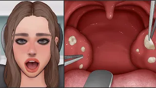 ASMR | Satisfying Tonsil Stone Removal Animation