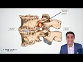 Anterior lumbar interbody fusion (ALIF) - Step by step procedure details, anatomy, & recovery review