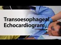Lagu Transoesophageal Echocardiogram