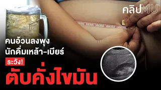 ใครมีความเสี่ยงต่อโรคตับคั่งไขมัน