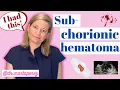 OBGYN Explains Subchorionic Hematoma My Story First Trimester Bleeding