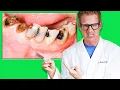 Dentist Reveals WHAT CAUSES CAVITIES How to PREVENT TOOTH DECAY