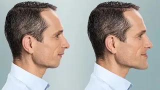 Can Braces Fix Jaw Misalignment Without Surgery Dr Parit Ladani 