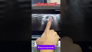  ทำไมการยกเวทถึงทำให้เกิดอาการปวดที่ข้อศอก และเกิดจากอะไรบ้าง 