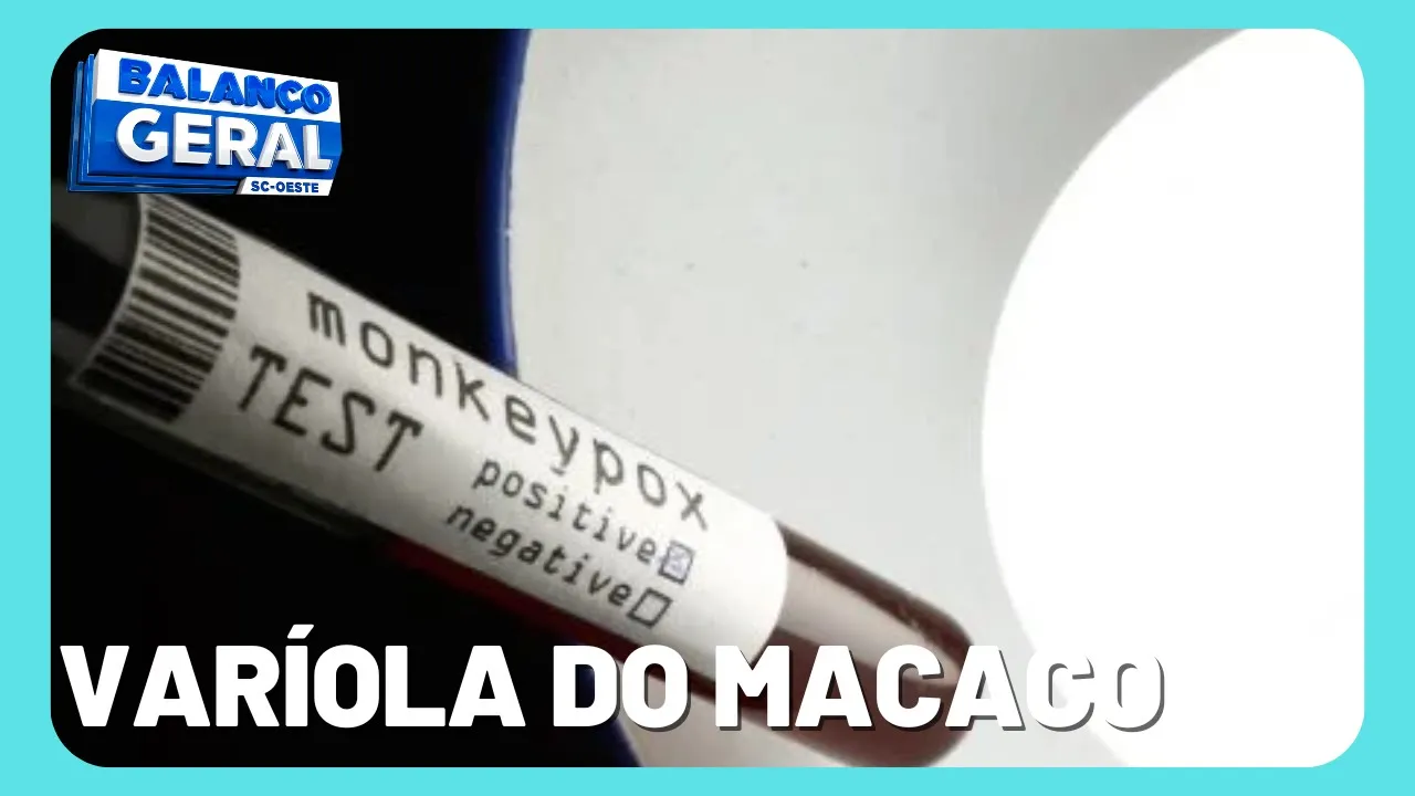 Criança de Chapecó diagnosticada com varíola dos macacos 'está bem'
