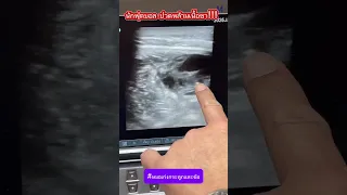  อาการบวมและก้อนแข็งที่ขาข้างขวาของนักฟุตบอลเกิดจากสาเหตุอะไร 