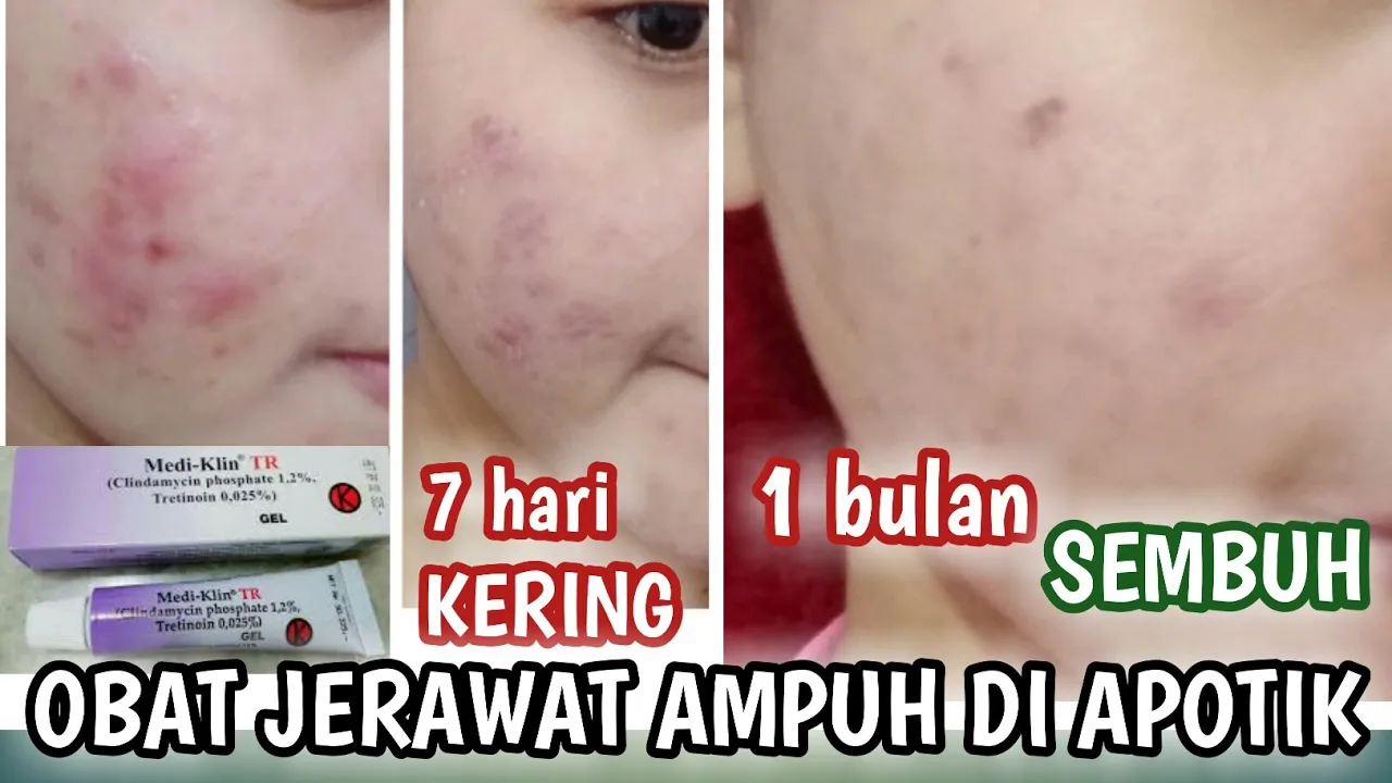 Cara Menghilangkan Bekas Jerawat - dr. Armansjah Dara. 