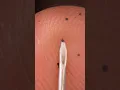 ASMR syringe under index finger skin CLOSE-UP macro - zoom in