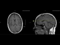 Unremarkable Non-Contrast Brain MRI Axial T1 - Example 1