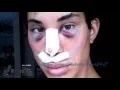 Justin Jedlica plastic surgery before and after