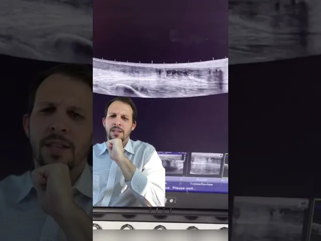 Achilles Tendon Tear on Ultrasound | Fort Lauderdale | Dr. Jorge Gonzalez, IROSM