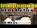Spondylolisthesis Real Patient Still Lives Active Lifestyle - No Meds