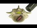 Transforaminal lumbar interbody fusion with Pedicle screws