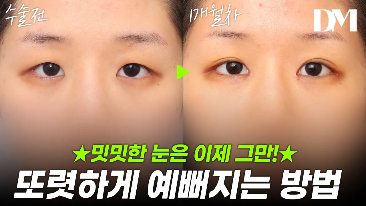밋밋한 눈은 그만! 눈이 또렷해지는 방법! 보여드릴게요~ #눈성형 #코성형 #매부리코