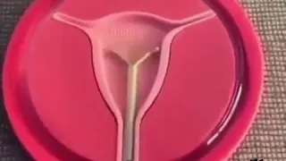 كيفيه تركيب اللولب داخل الرحم لمنع الحمل عند المرأه دندنها