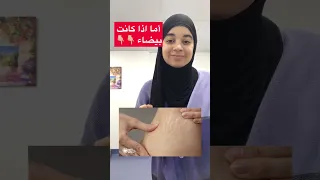 هل يوجد علاج لع لامات تمدد الجلد 