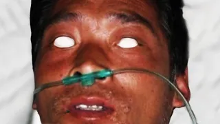 La Peor Muerte Por Radiacion 83 Dias en el INFIERNO Accidente Hisashi Ouchi