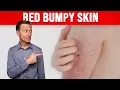 Perfect Remedy for Keratosis Pilaris CHICKEN SKIN