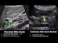 Download Lagu Bile Duct Ultrasound Normal Vs Abnormal Image Appearances | Biliary Tract Abnormalities USG Scan