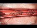 See how the Pounce Thrombectomy Platform works