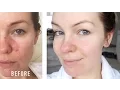 Download Lagu HOW I CURED MY ROSACEA // IRRITATION // REDNESS // MY STORY