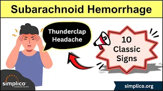 Subarachnoid Hemorrhage - 10 Signs & Symptoms [Brain Aneurysm] #nursing