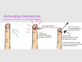 BoneTalks - FingerTip and Nailbed Injuries (Tuft Fracture)