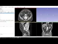 3D Slicer Tutorial Manual segmentation Thresholding