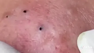 تنظيف حبوب وبثور الوجه راحة نفسية يرجى الاشتراك بالقناة 