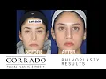 Rhinoplasty Nose Job Testimonial for Dorsal Hump Reduction Dr Anthony Corrado