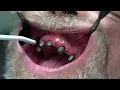 5 TRIOS Intraoral Scanner Full arch on implants scan