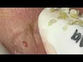 Loan Nguyen Acne Treatment 1396h