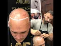 Scalp Micropigmentation step by step with Antonio Baroque BAROQUE BEAUTY CENTER