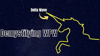 EKG Wolff Parkinson White Syndrome WPW Pathology With AVRT And Preexcitation 